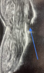 volar plate fracture ultrasound